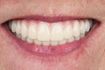 All on 4 implant tedavisi karşılaştırması sonrası görünüm