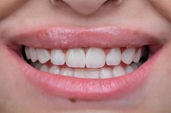 Dental bonding tedavisi karşılaştırması sonrası görünüm