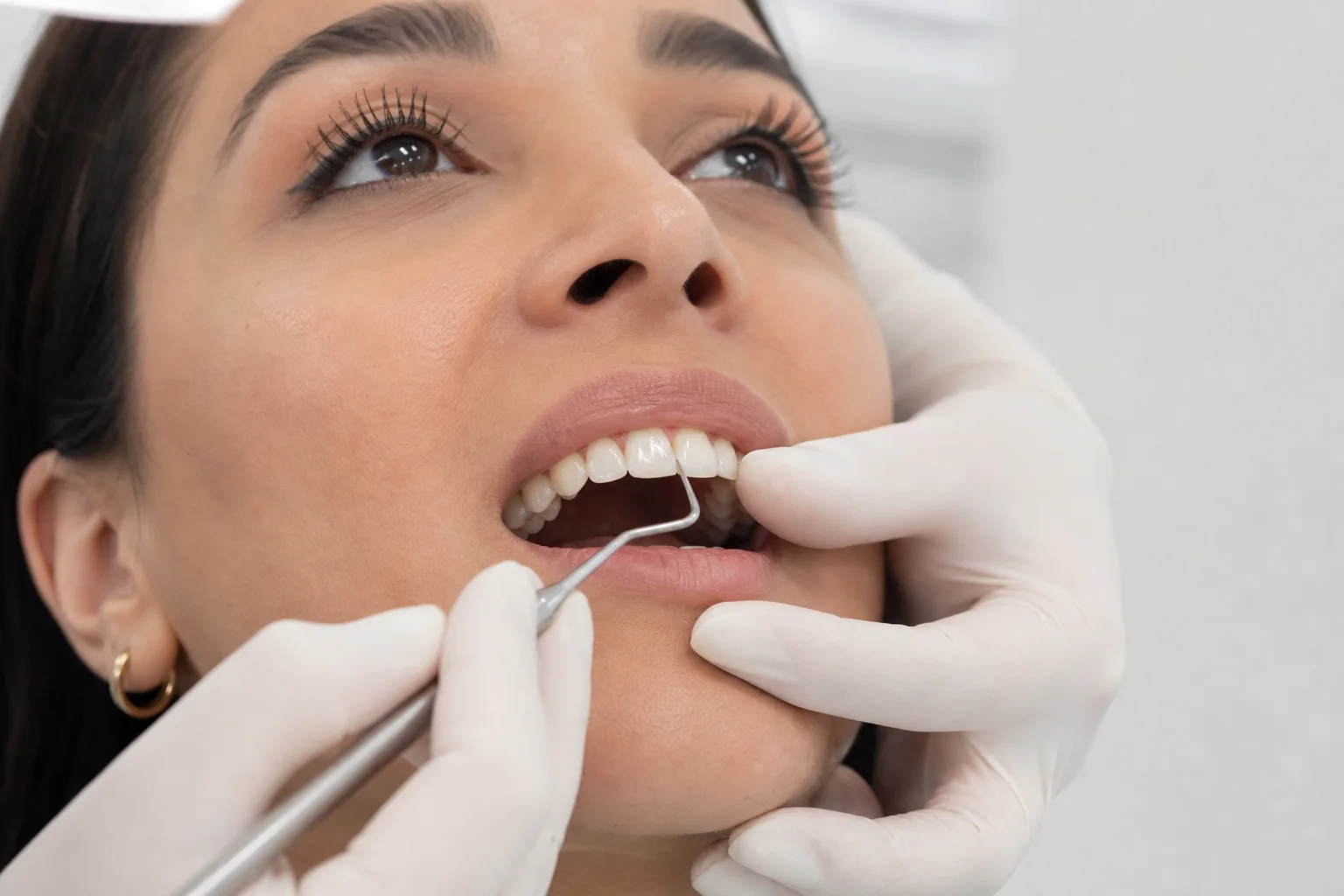 Hollywood Smile kapsamında bonding ile diş formunun düzenlenmesi