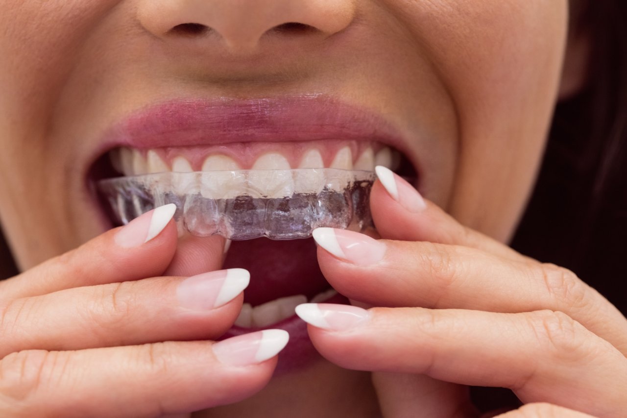 Telsiz Diş Düzeltme Ankara: Analiz Dent ile Invisalign Konforunu Keşfedin!